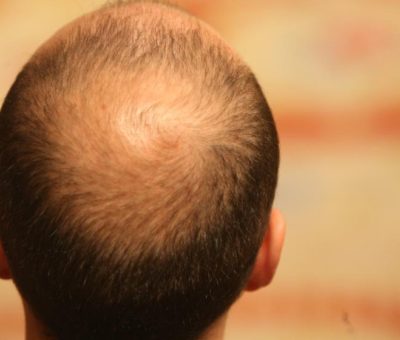 Existen factores que generan caída del cabello: IMSS