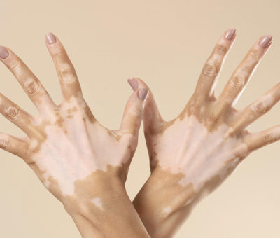 Existen factores que deben evitarse para no desencadenar vitiligo: IMSS