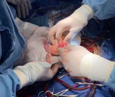 Médicos del Hospital de Cardiología No. 34 del IMSS en Nuevo León realizan trasplante de corazón