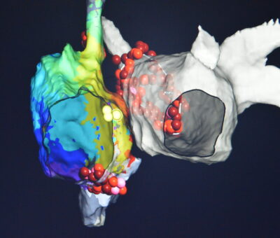 SSG realiza reconstrucción tridimensional de un corazón con dos arritmias cardiacas