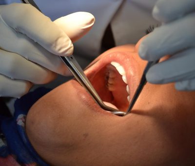 SSG registra 586 casos de gingivitis y enfermedad periodontal en la primera semana del año