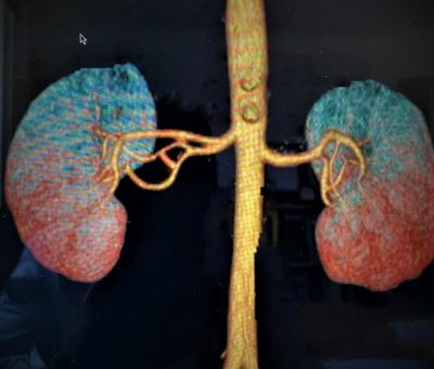 Esperan un trasplante 1655 guanajuatenses en su mayoría de riñón