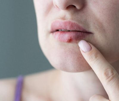 Besos, principal medio de transmisión de herpes labial; 7 de cada 10 personas lo portan y lo pueden contagiar por contacto