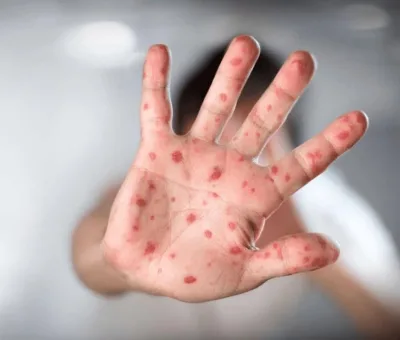 Orienta IMSS Guanajuato a población para prevenir contagios de sarampión