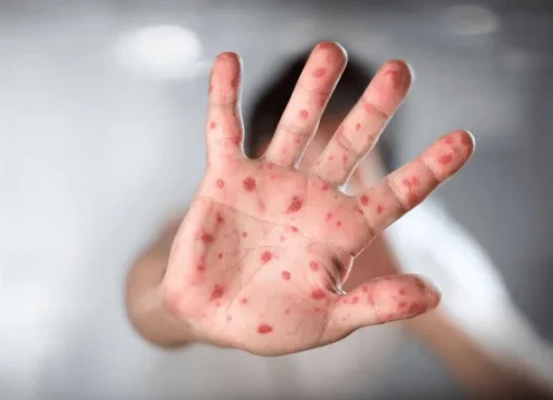 Orienta IMSS Guanajuato a población para prevenir contagios de sarampión